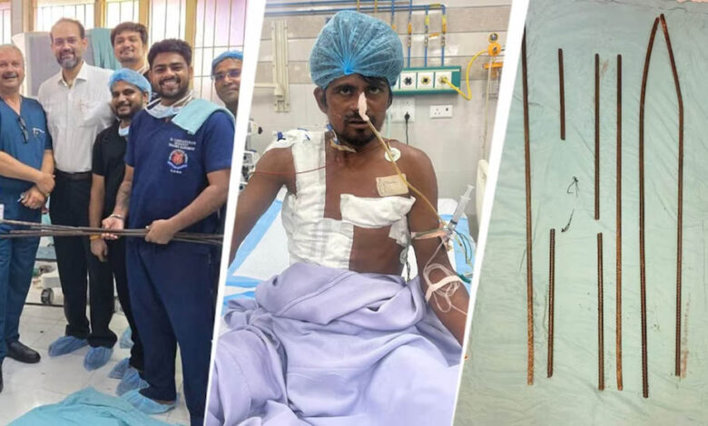 शरीर में आर-पार घुसे 4 लोहे के सरिये, KGMU के डॉक्टरों ने साढ़े आठ घंटे की सर्जरी से बचाई मजदूर की जान 1 18A18